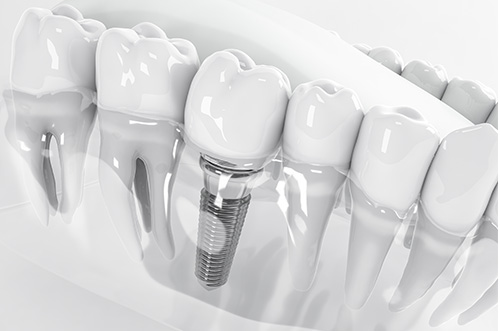 3D illustration of a dental implant in a transparent lower arch with a white background