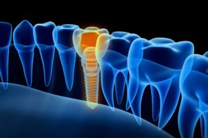 Digital model of a dental implant